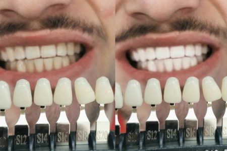 NUR KOSMETIK FREIBURG Zahnbleaching Zahne zahnreinigung weis beaty studio qb6al1a9v4mnl915z3ws6i84c3du0s2x0mtx8kbx2w